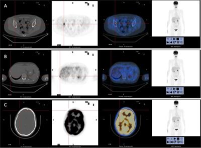 Maintained complete response to talazoparib in a BRCA-2 mutated metastatic luminal breast cancer: case report and review of literature